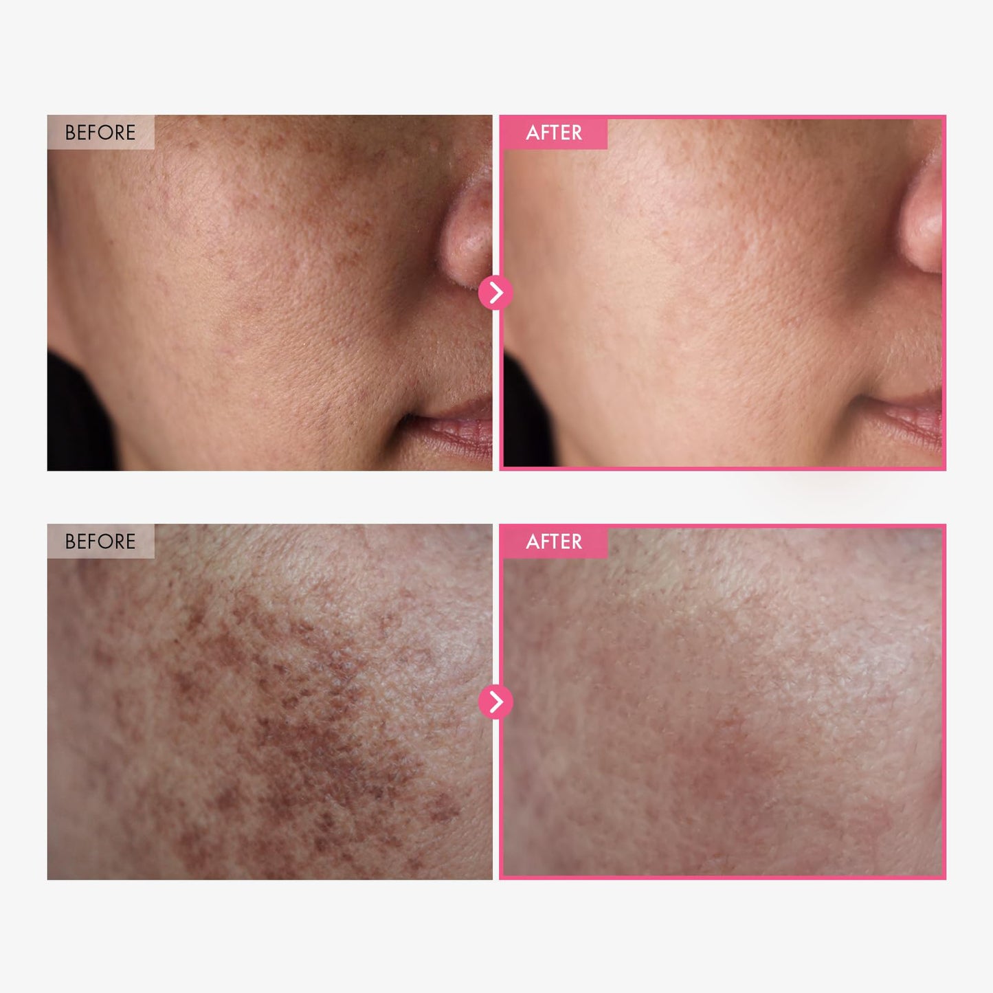 š LOVILDS⢠Arbutin 7% + Tranexamic Acid 4% Brightening Cream | Targets Dark Spots, Freckles, Blemishes & Pigmentation